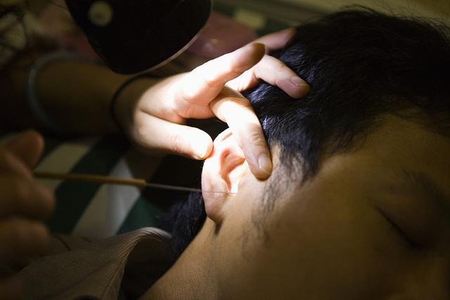 27岁女子采耳后反复真菌感染耳道长“白毛”,医生:采耳需谨